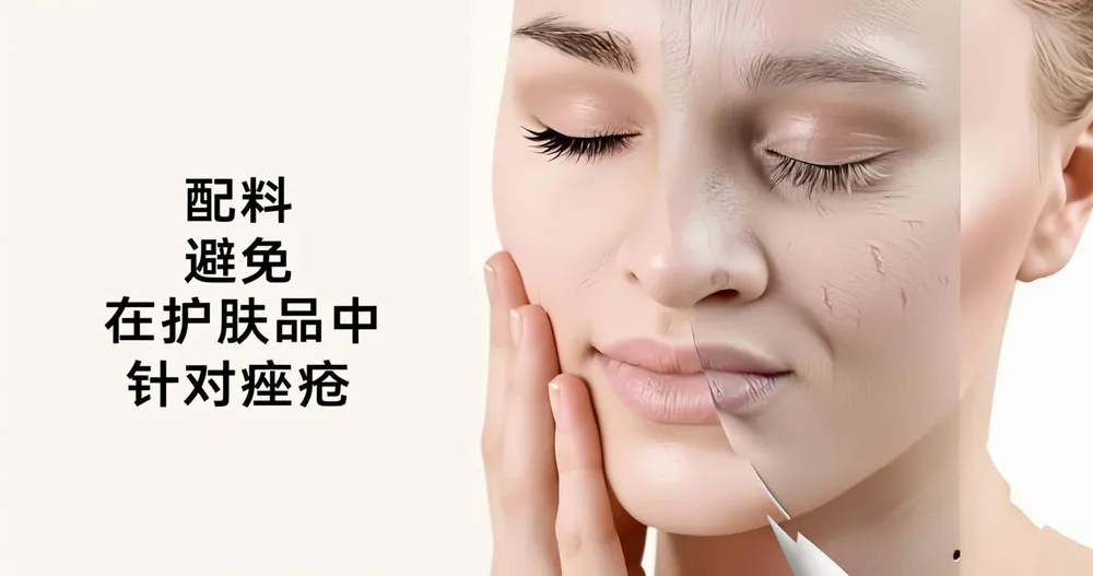 护肤中应避免的成分（针对痤疮）