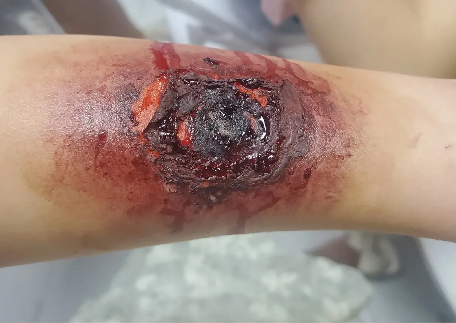 Burned Skin Wound