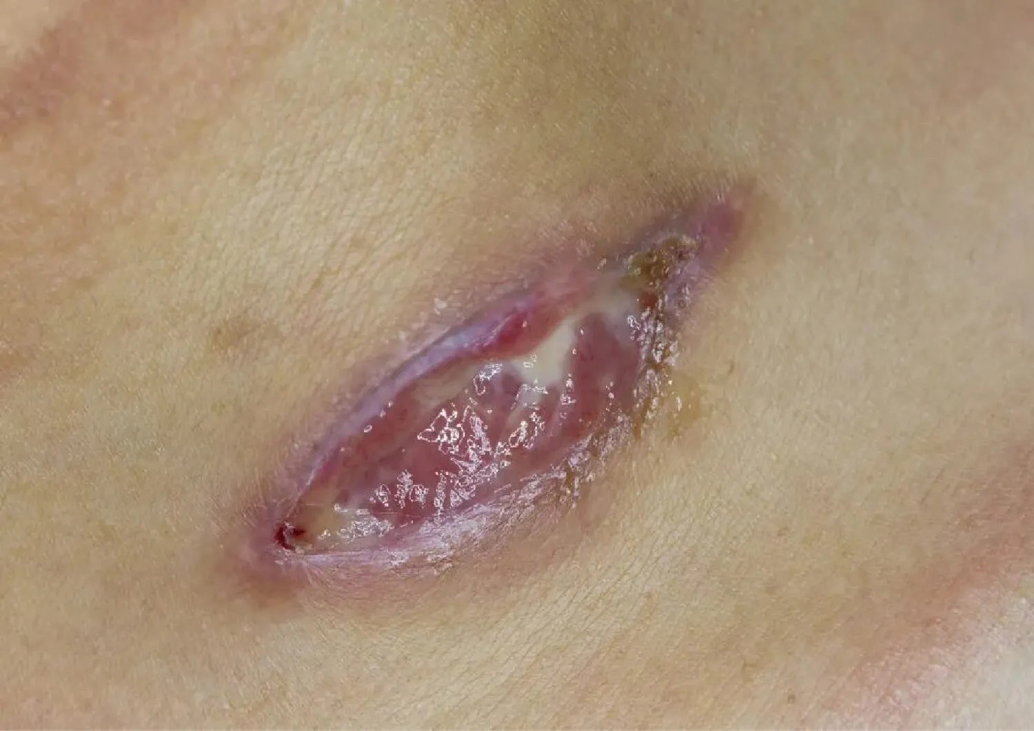 Chronic wounds