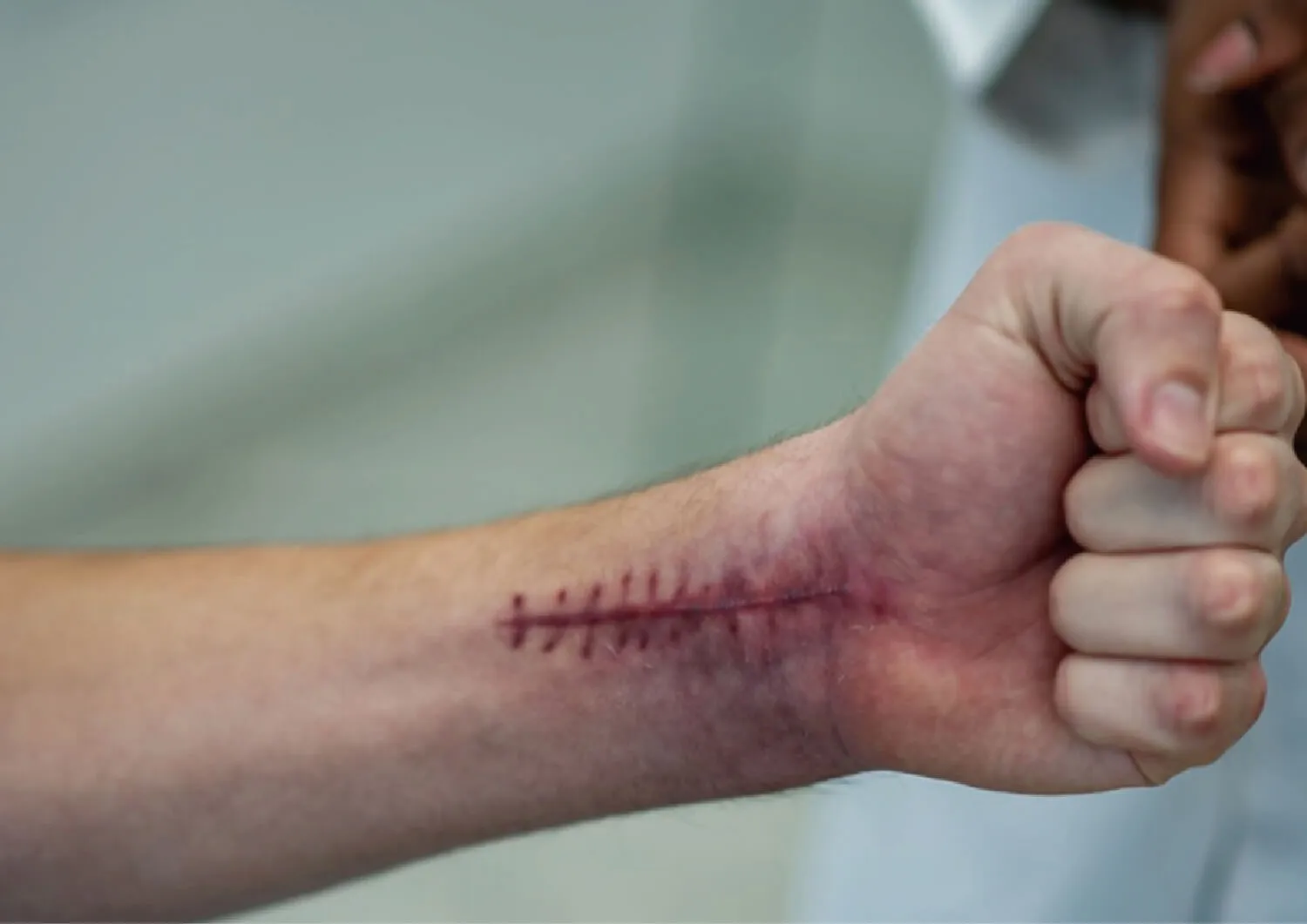 Combat knife wounds
