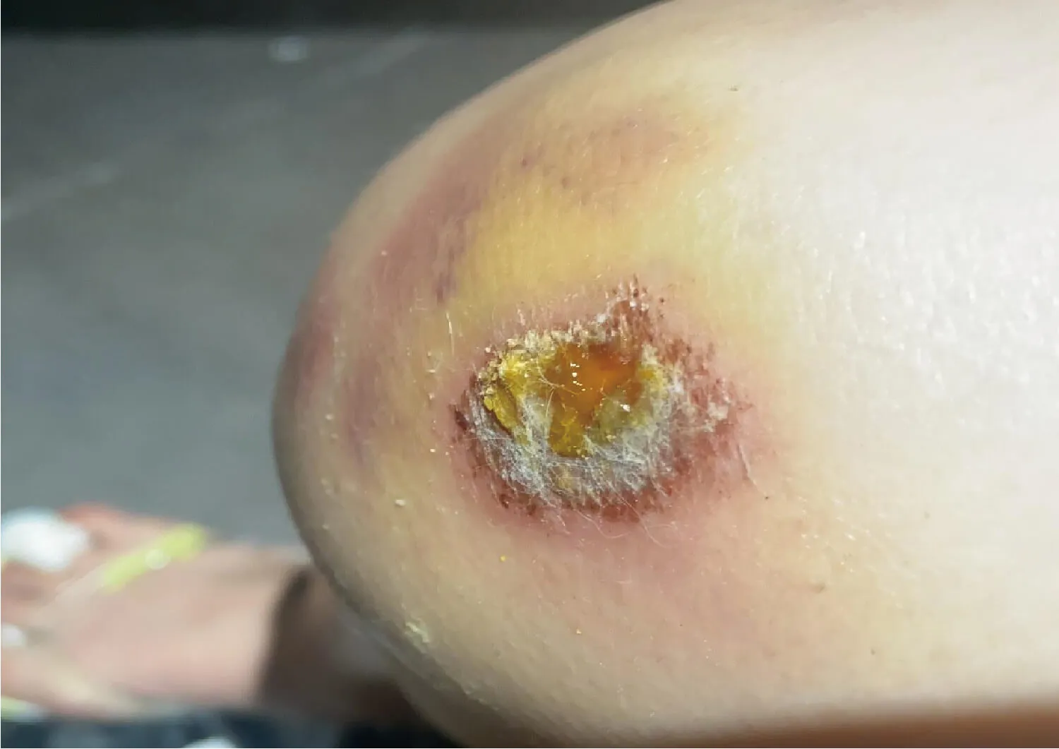 Delayed healing wound