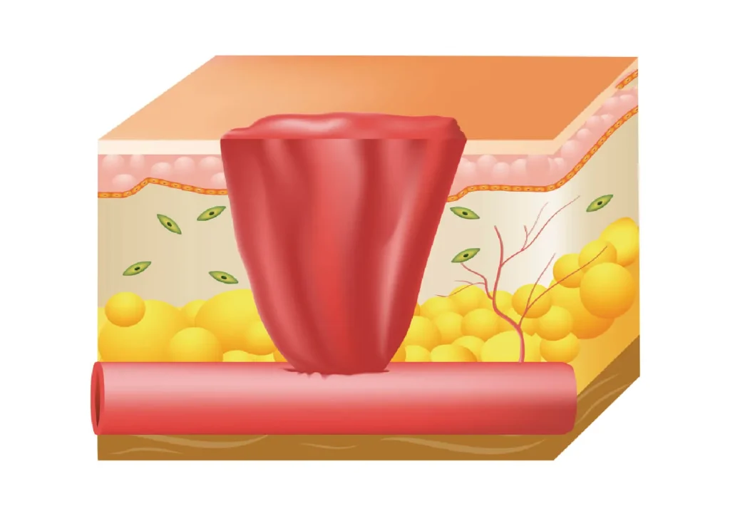 Hemostasis Stage
