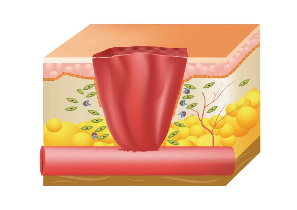 Inflammatory stage