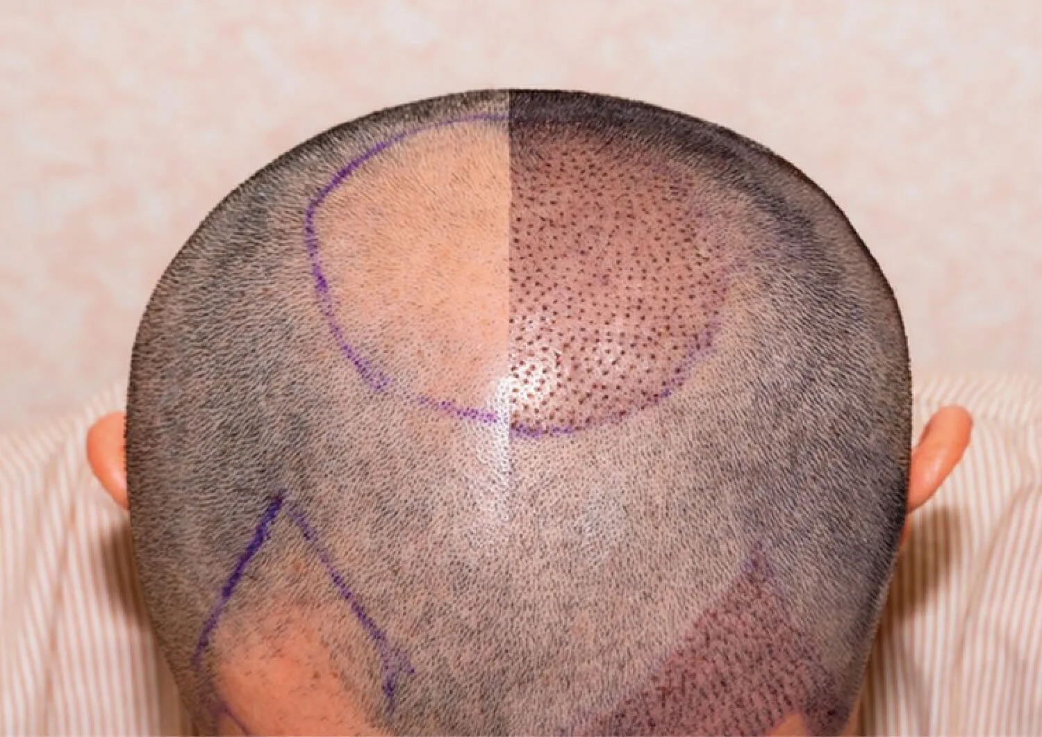 Post-Hair Transplant