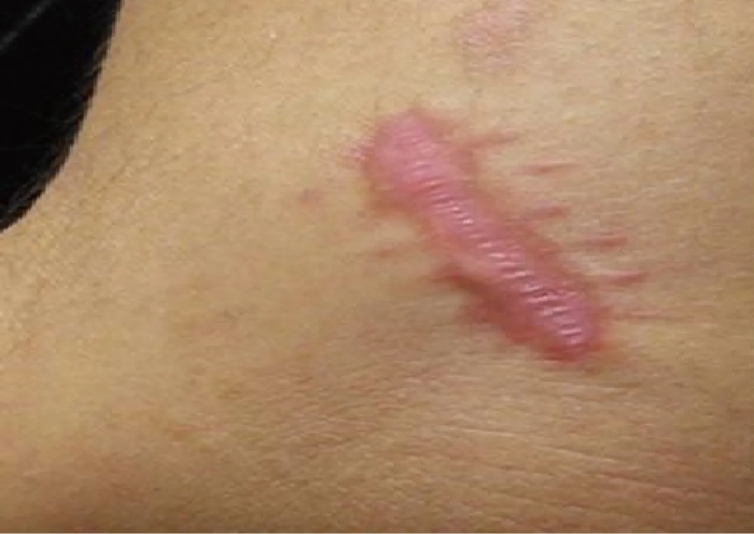 Scar formation