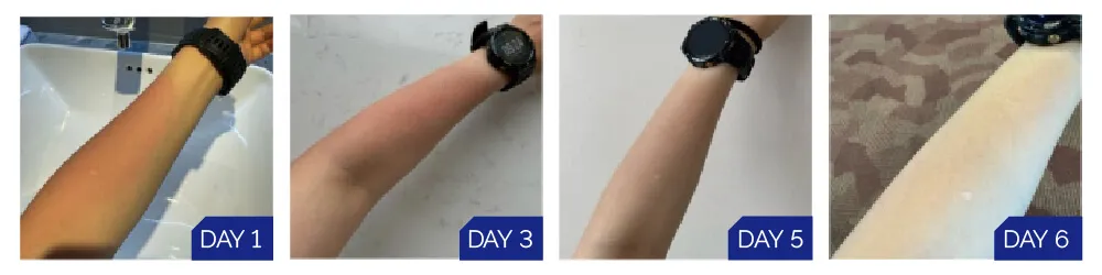 medical dressing spray type case study