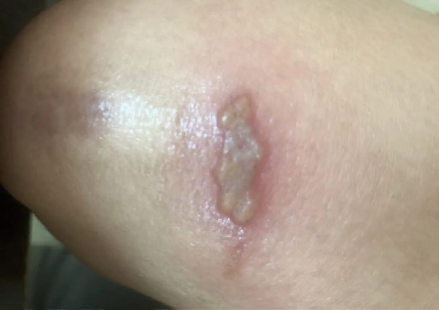 skin infection